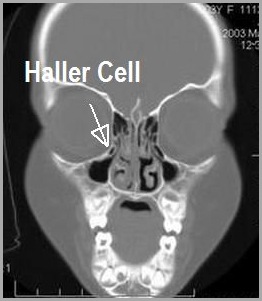 haller cell