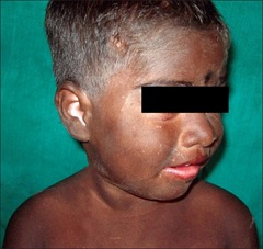 Carbon baby syndrome:
