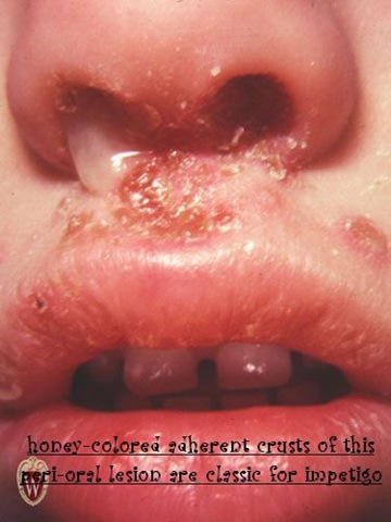 [impetigo[3].jpg]