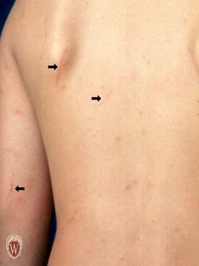 [excoriation[3].jpg]