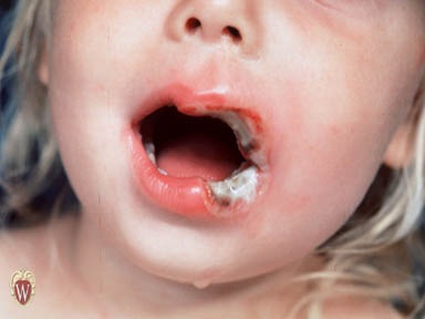 [ulcer[3].jpg]