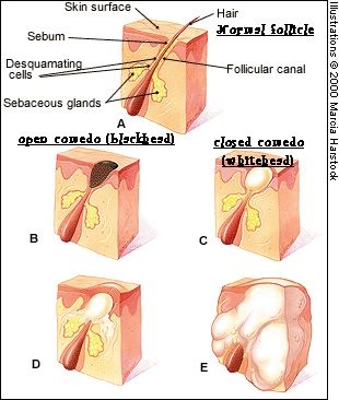 [acne[6].jpg]