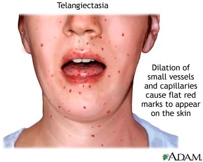 [Telangiectasia[3].jpg]