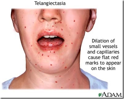 Telangiectasia