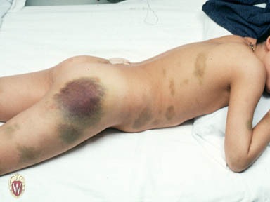 [ecchymosis[2].jpg]