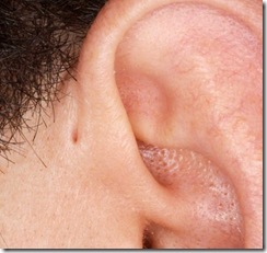 preauricular pit