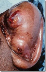 hematoma