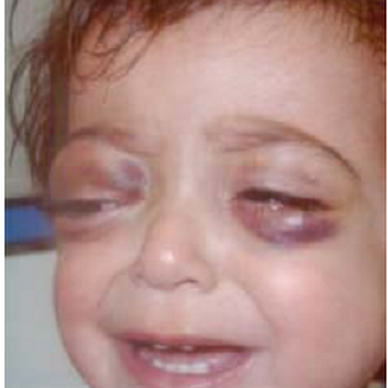 Awas ! kanker neuroblastoma pada balita...