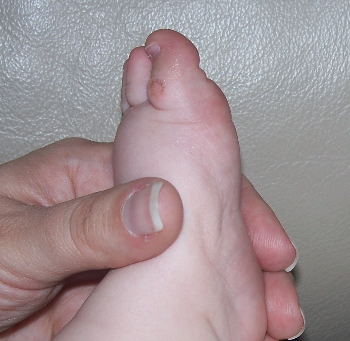 [blister 008[3].jpg]