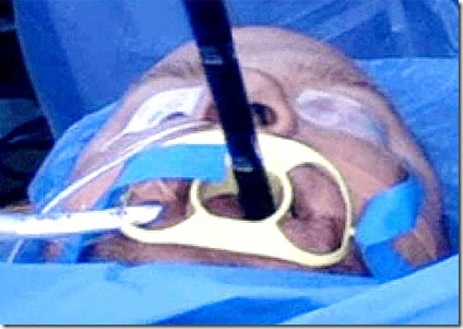 Jeff Scholz  Appendix removal surgery