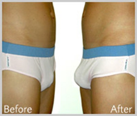beforeafter