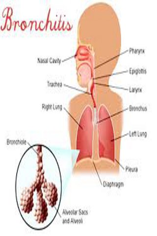 【免費健康App】Bronchitis Guide!-APP點子