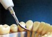 Escareador Ultrasonico Dental