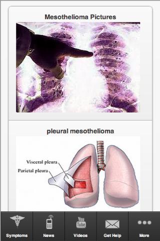 Mesothelioma and Asbestos Help