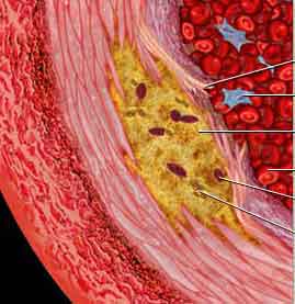 atherosclerosis-6782320.jpg