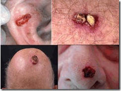 cancer de pele