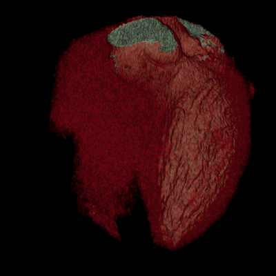 Coração 3D por Tomografia Computadorizada