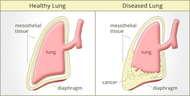 What is Mesothelioma Cancer  Symptoms u0026 Treatment