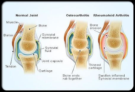 Rheumatoid Arthritis Treatment Screenshots 5