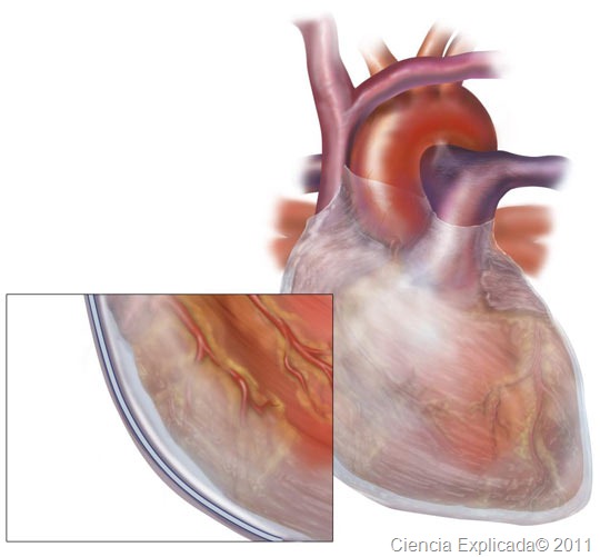 [pericardititis%255B2%255D.jpg]