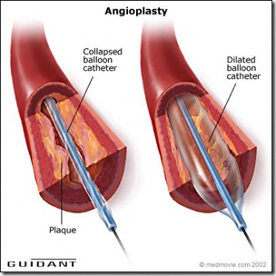 Angioplast