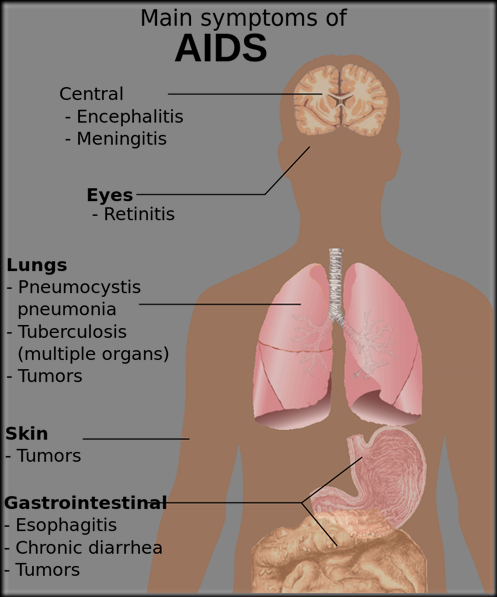 800px-Symptoms_of_AIDS.svg