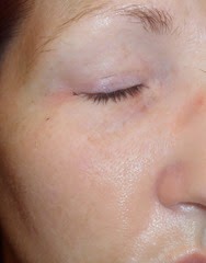skin after Rodan   Fields Acute Care Regimen_2