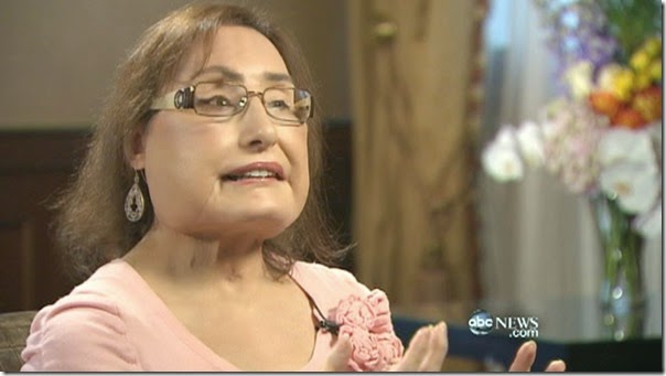 connie culp fotos transplante cara (10)