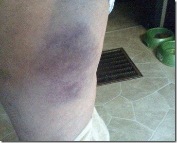 bruise day 3