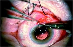 [Eye.Surgery4.jpg]