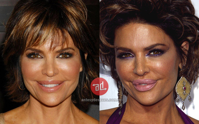 Lip augmentation of Lisa Rinna