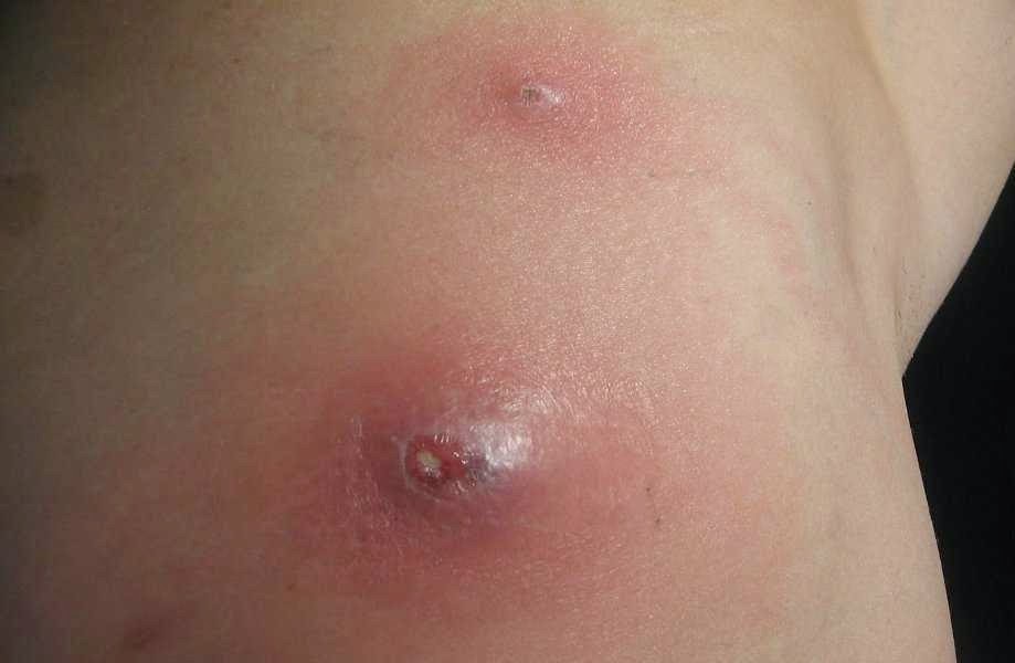 [home-remedies-for-boils-on-face4.jpg]