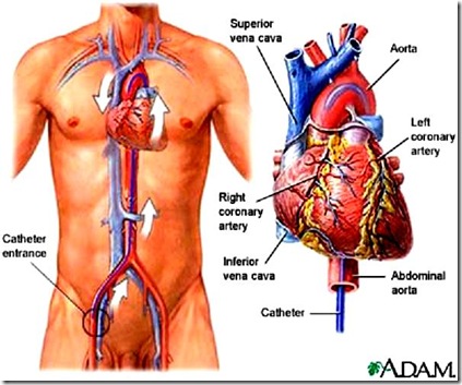 Heart Cath Procedure