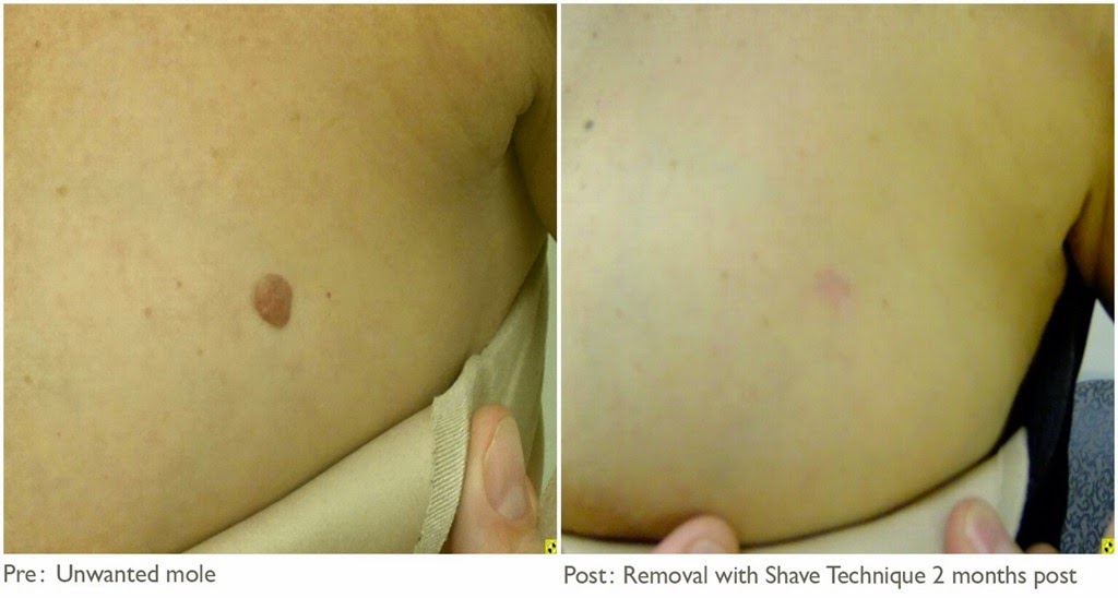 [home%2520remedies%2520for%2520mole%2520removal_4%255B4%255D.jpg]
