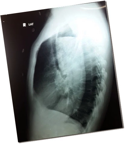 Xray showing dilated esophagus filled with food