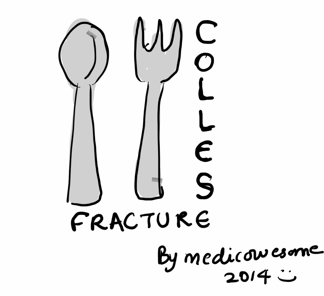 Colles Fracture Dinner Fork