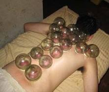 cupping-what is cupping-hijama-benefits