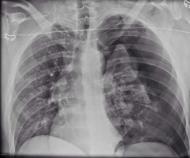 Dr. Key: CXR of pneumothorax