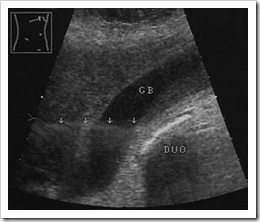 Ultrasound images artifact in a stonefree gallbladder - Radiology Imaging