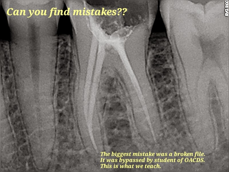 ODONTOS ACADEMY FOR CLINICAL DENTAL STUDIES How to bypass a broken K