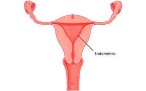 endometrio