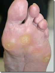 Wikipedia PDF callosidades en los pies callo en plantas del pie y manos como quitarlos y eliminarlos paso a paso con Podologia