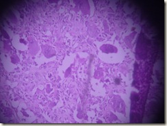 giant cell tumour histology slide