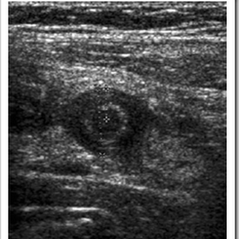 Ultrasound Images Of Acute Appendicitis Radiology Imaging