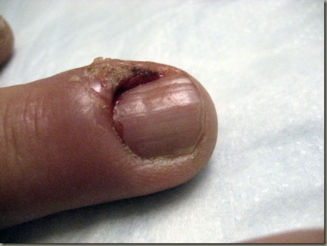 Finger Post Treatment