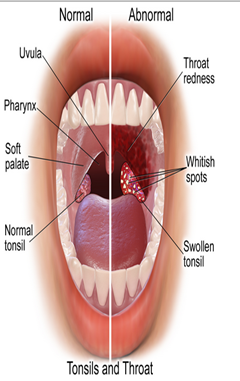 Penyakit tonsilitis