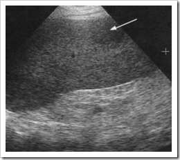 splenic spleen disease ultrasound hypoechoic lesion hyperechoic malignant radiology focal enlarged arrow small