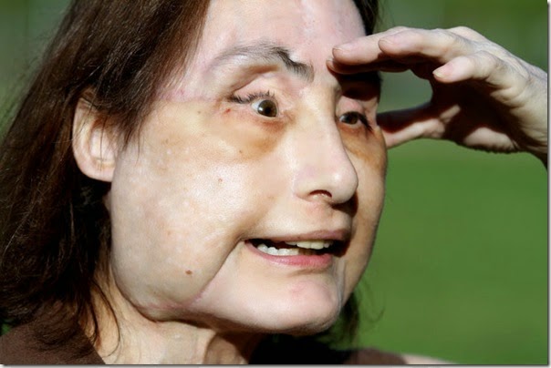 connie culp fotos transplante cara (8)