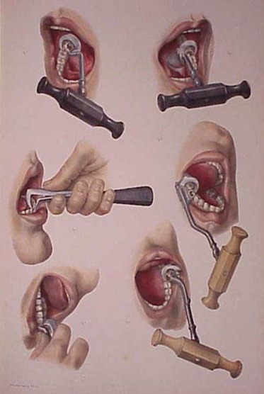 Use of the dental key