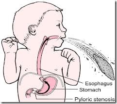 vomiting in gastric outlet obstruction pyloric stenosis